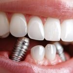 How Dental Implants Maintain Their Stability During Temperature Changes and Everyday Eating